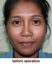 plastic_surgery_augmentation_rhinoplasty